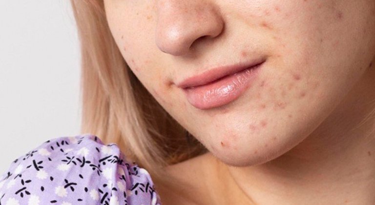 Gesichtsbereich einer jungen Frau mit Pigmentflecken