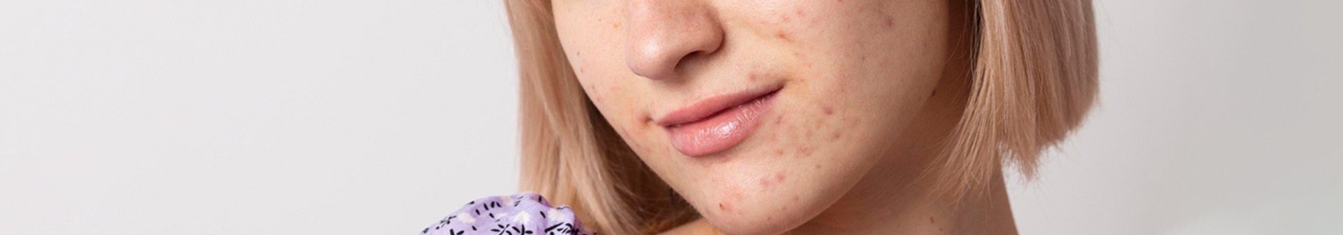 Gesichtsbereich einer jungen Frau mit Pigmentflecken