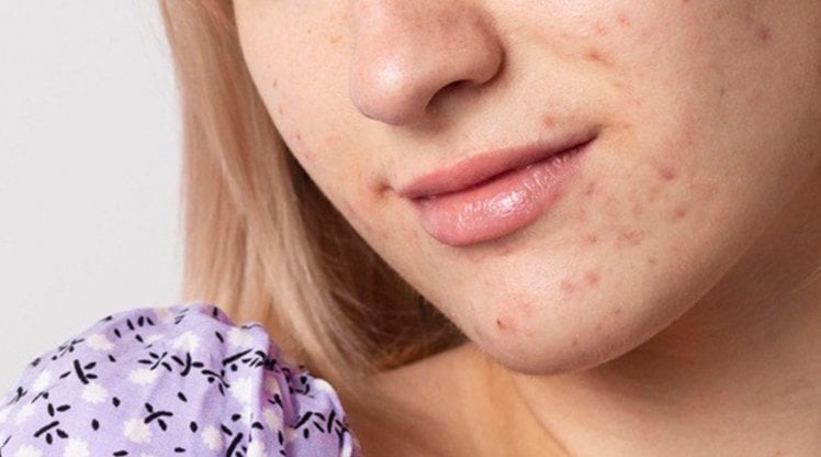 Gesichtsbereich einer jungen Frau mit Pigmentflecken