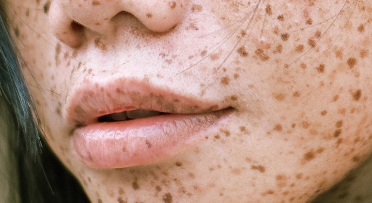Ausschnitt eines Frauengesichts von der Nase bis zum Mund mit schwarzen Haaren und Pigmentflecken im Gesicht