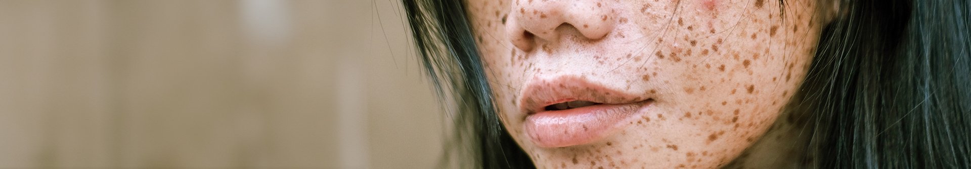 Ausschnitt eines Frauengesichts von der Nase bis zum Mund mit schwarzen Haaren und Pigmentflecken im Gesicht
