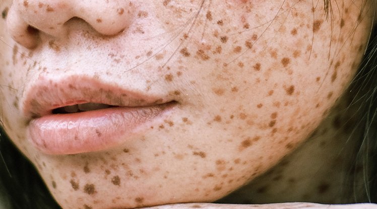 Ausschnitt eines Frauengesichts von der Nase bis zum Mund mit schwarzen Haaren und Pigmentflecken im Gesicht