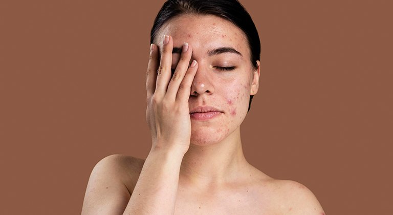 Eine Frau mit unreiner Haut fasst sich in ihr Gesicht