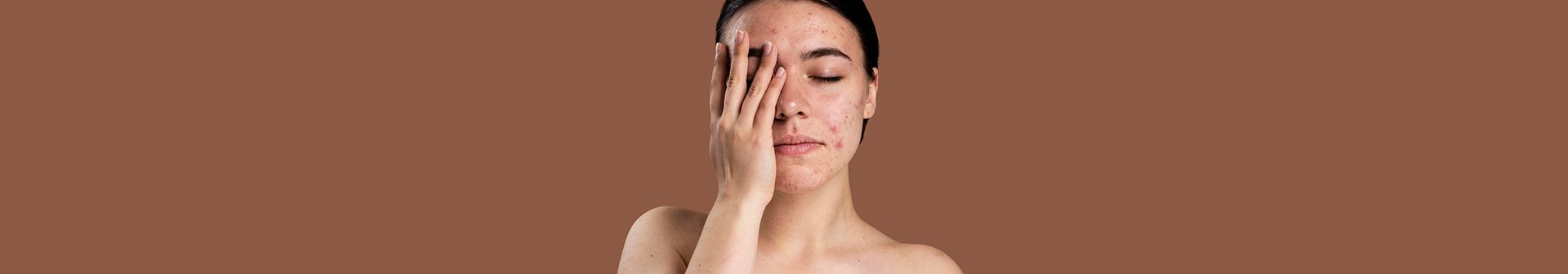 Eine Frau mit unreiner Haut fasst sich in ihr Gesicht