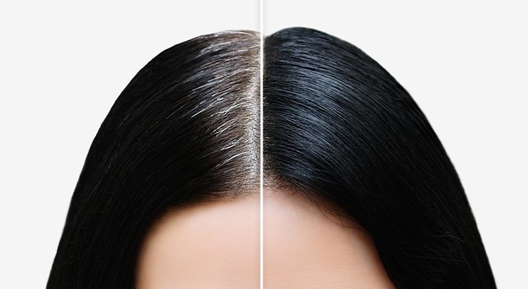 Beispiel für Haaransatz kaschieren