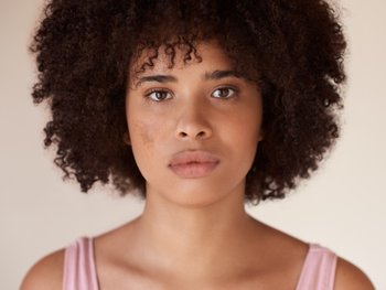 Junge Frau mit Pigmentflecken im Gesicht, die durch Sonneneinstrahlung auf die Haut entstehen können