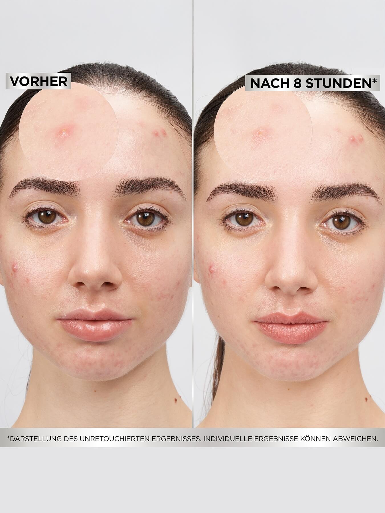 Vorher-Nachher-Vergleich bei Produktanwendung von Garnier 8H Invisible Pimple Patch