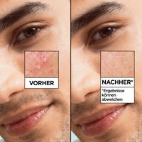 Das Garnier Hautklar Salicylic Anti-Unreinheiten Serum mildert Unreinheiten sichtbar, wie am Beispiel dieses Models möglich.