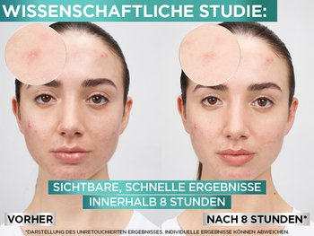 Vorher Nachher Bild nach Anwendung der Pimple Patches